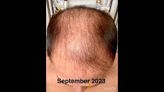 My Secret Hair Growth In A Year haircare hairgrowth neohair hairtransform [upl. by Irme939]