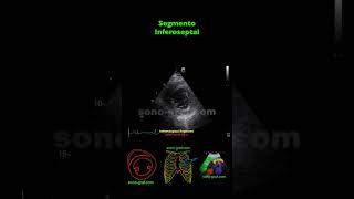 Ecocardiografía  Hipocinesia Inferolateral E Inferior [upl. by Leunamme]