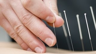 Acupuncture Successfully Treats High Cholesterol [upl. by Kacy46]