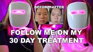 DOES IT WORK Neutrogena Light Therapy Acne Mask [upl. by Jehanna537]