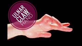 ULNAR CLAW HAND [upl. by Muffin904]