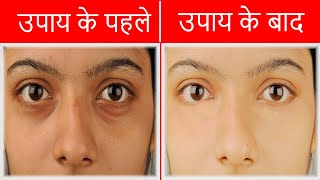 dark circle का कारण क्या हैं  treatment of dark circles [upl. by Ahsinuq]