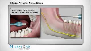 Inferior Alveolar Nerve Block [upl. by Adiahs681]