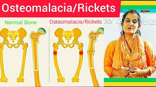 Osteomalacia amp Rickets  Cause Symptom Treatment Diagnosis MedicalSurgical amp Nursing Management [upl. by Ycram174]