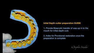 Veneer preparation GUIDE Initial Depth cutter [upl. by Francene]