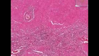 Histopathology Spleen Amyloidosis [upl. by Mata282]