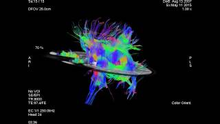 GLIOMA DE QUIASMA OPTICO TRACTOGRAFIA EN DIFUSION [upl. by Towers]