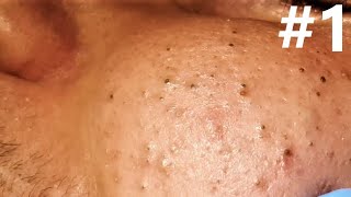 BIG BLACKHEADS EXTRACTIONS on Happy   1 [upl. by Ilellan]