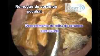 The Biggest Earwax removal by otoendoscopic technique everA Maior cera de ouvido do mundo [upl. by Anawait]