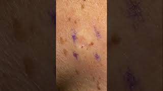 Age Spot Removal  Completely Gone [upl. by Ellener]