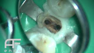 Upper premolar retreatment and post amp core build up [upl. by Akerdnuhs]