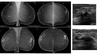 Breast Pathology  Infiltrating Lobular Carcinoma ILC [upl. by Welcy]