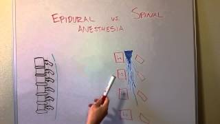 Epidural vs Spinal Anesthesia [upl. by Barcot]