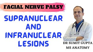 FACIAL NERVE PALSY [upl. by Bryn210]