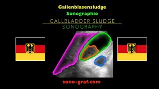 Sonographie  Gallenblasensludge [upl. by Asen]