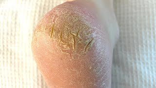 Severely Cracked Callused And Painful Heel Is Treated  Satisfying Skin Removal [upl. by Aihcats543]