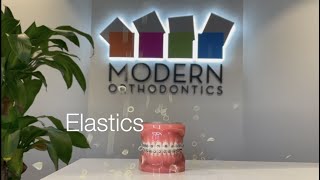 What are Elastics Rubber bands in Orthodontics [upl. by Kcirdnek]