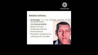 Acromegaly physiotherapy physiology youtube shorts [upl. by Frasquito809]