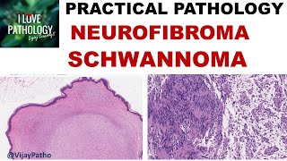 NEUROFIBROMA AND SCHWANNOMA Clinical features amp Morphology [upl. by Nauj601]