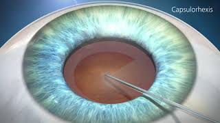 Cataract Surgery Animation [upl. by Adnarahs885]