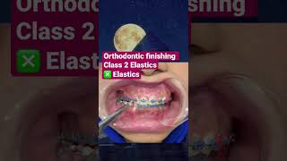 Orthodontic Smile  Class 2 Elastics ❎ Elastics [upl. by Essyla]