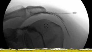 Inadvertent Deltoid Muscle Injection under Fluoroscopy  ThePainSourcecom [upl. by Phia562]