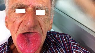 ANGIOEDEMA  Causes Symptoms Treatment Diagnosis  Hereditary Angioedema  Angiodema vs Urticaria [upl. by Marcile38]