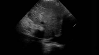 IVC Fully Collapsing with Spontaneous Respiration [upl. by Aguste]