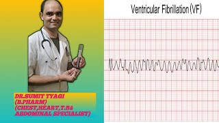 VENTRICULAR FIBRALATION BY DRSUMIT TYAGISUMITMEDICALDISPENSARY1 [upl. by Nalim]