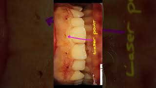 Laser gingivectomy [upl. by Ahtikal]