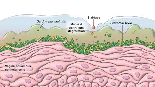 Bacterial Vaginosis  Pathogenesis [upl. by Fifi]