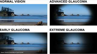 Glaucoma  An Introduction for Patients [upl. by Flessel]