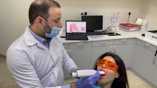 Dental digital impression dental scanning by 3shape for clear aligner putting the attachment on [upl. by Gunther]