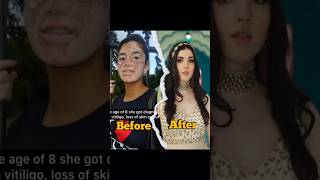 aastha shah transformationaastha shah before and after vitiligo shorts [upl. by Erine]