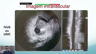 CARDIOLOGIA INTERVENCIONISTA 2024  IMAGEM INTRAVASCULAR [upl. by Anuaf]