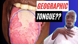 What is a Geographic Tongue  Benign Migratory Glossitis Treatment for a Geographic Tongue [upl. by Annasoh92]