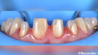 Split Dam technique rubber Dam Isolation For anterior teeth [upl. by Lon]