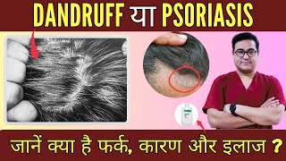 Dandruff Vs Scalp Psoriasis  डैंड्रफ Vs सोरायसिस  Health Mantra With Dr Vikram [upl. by Roid538]