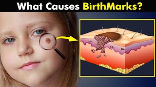 Birthmarks  How Birth Marks Develops In Our Skin UrduHindi [upl. by Kallman]