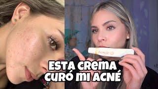 CREMA CURÓ MI ACNÉ acnoic gel peroxido de benzoilo y adapaleno [upl. by Juxon]