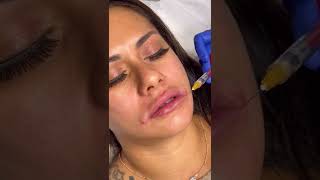 Lip filler cannula technique [upl. by Kavanaugh]