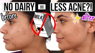 I Went Dairy Free for 30 Days to Help My Acne Heal [upl. by Yeblehs]