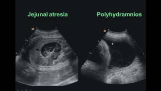 Anomalies of the Fetal Gastrointestinal amp Genitourinary Tracts [upl. by Nithsa665]