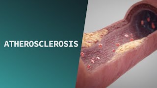 Atherosclerosis  Pathologies [upl. by Eltsirhc]