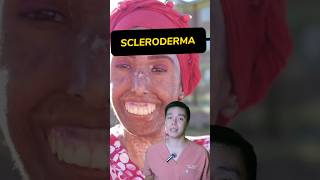 How to operate SCLERODERMA surgeonph viralvideo viralshorts fyp foryou foryoupage scleroderma [upl. by Angelika]