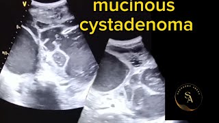 Ultrasound Imaging mucinous Cystadenoma [upl. by Lehet]