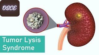 Tumor Lysis Syndrome Made Easy  Medicine Simplified  GMDC Diagnostic Exam [upl. by Schofield852]