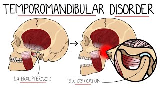 Temporomandibular Joint Disorder Explained TMJ Dysfunction  Includes Treatment amp Anatomy [upl. by Eceirahs]