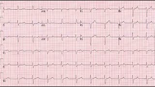 ECG Interpretation Tutorial  ChalkTalk 300 Advanced Level [upl. by Ycnay]