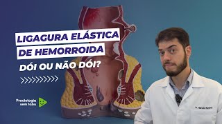 Ligadura elástica doi ou não doi Ligadura elástica de hemorroidas [upl. by Naols]